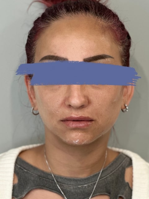 Before Female Lip Fillers procedure at our Montreal aesthetic clinic