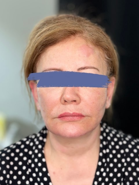 Before Female Radiesse Jawline Fillers procedure at our Montreal aesthetic clinic