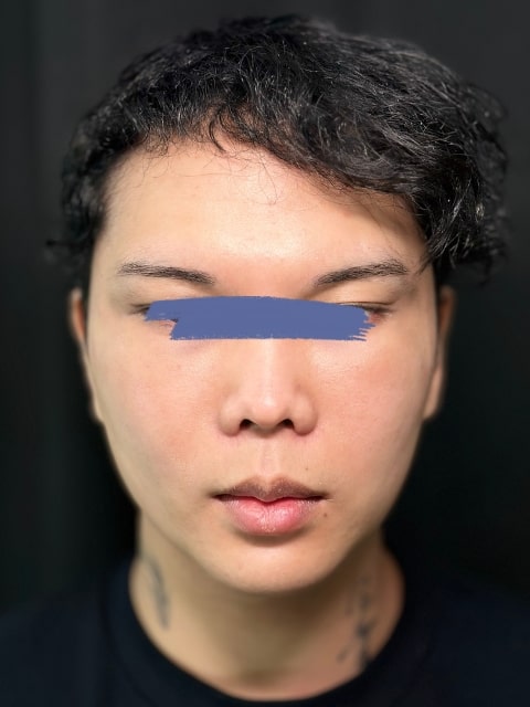 Before Male Cat Eyes PDO thread lift procedure at our Montreal aesthetic clinic