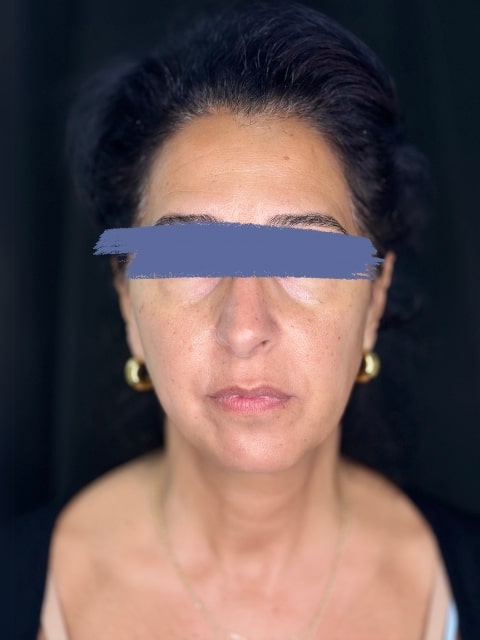 Before Female Cheeks and Marionette Lines Dermal Fillers procedure at our Montreal aesthetic clinic