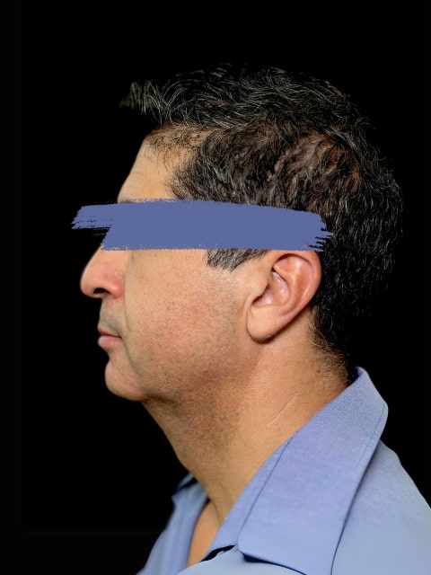 Before Male Jawline Fillers procedure at our Montreal aesthetic clinic