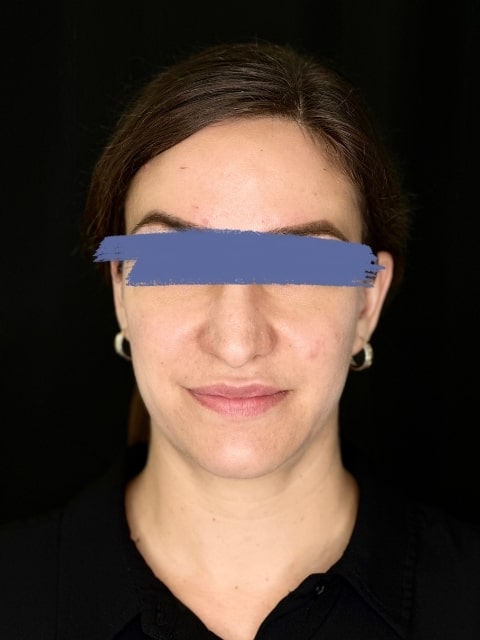 Before Female Cheeks and Lips Dermal Fillers procedure at our Montreal aesthetic clinic