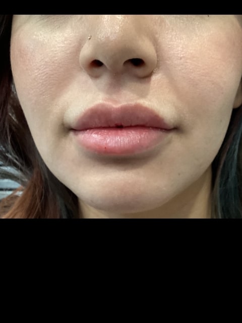 Before Female Lip Fillers procedure at our Montreal aesthetic clinic