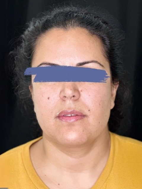 Before Female Lip Fillers procedure at our Montreal aesthetic clinic