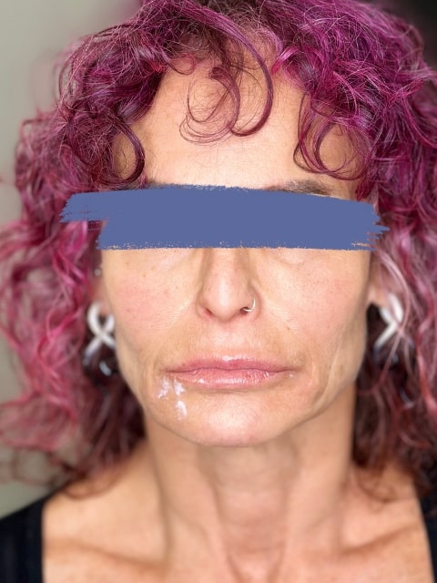 Before Female Lip Fillers procedure at our Montreal aesthetic clinic