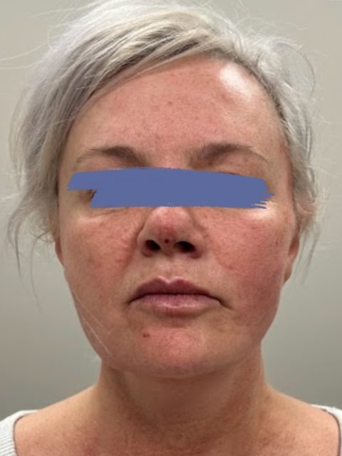 Before Female PDO thread nose lift procedure at our Montreal aesthetic clinic