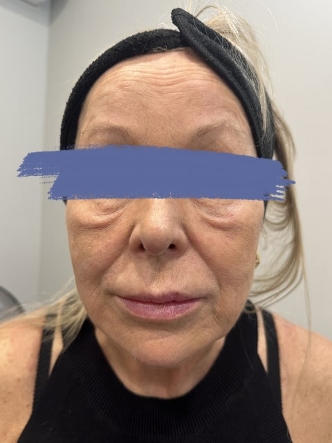 Before Female Dermal Fillers procedure at our Montreal aesthetic clinic