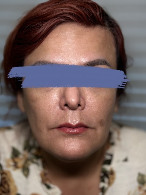 Before Male Lip Fillers procedure at our Montreal aesthetic clinic