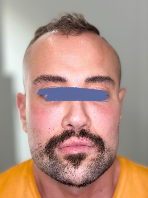 Before Male Cat Eyes PDO thread lift procedure at our Montreal aesthetic clinic