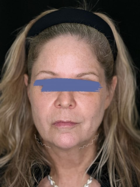 Before Female Jawline PDO thread lift procedure at our Montreal, Quebec aesthetic clinic (frontal view)