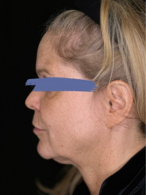 Before Female Jawline PDO thread lift procedure at our Montreal, Quebec aesthetic clinic (side view)