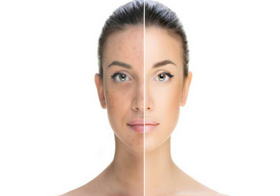 Revive Your Complexion: Advanced Protocol for Melasma and Acne