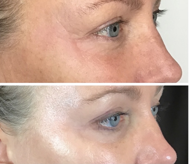 Nitrogen Injection at Ideal Body Clinic