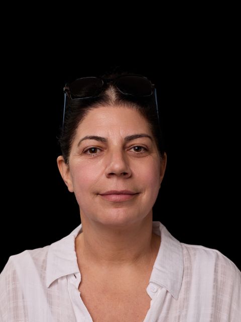 After picture: trilift under the eye treatment in Montreal