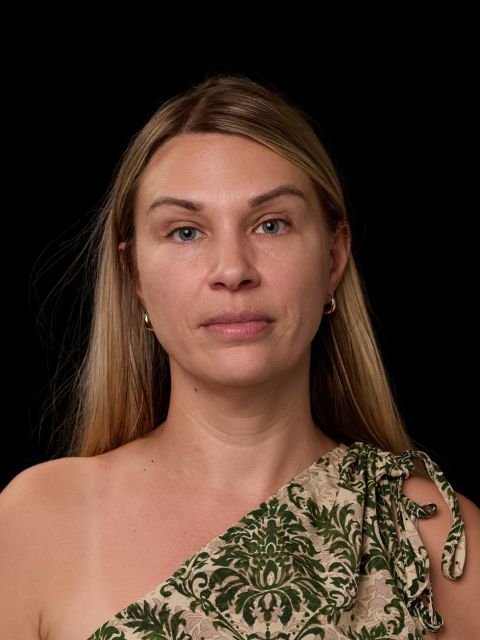 Before picture: triLift non surgical face lift treatment for middle age woman in Montreal at Ideal Body Clinic