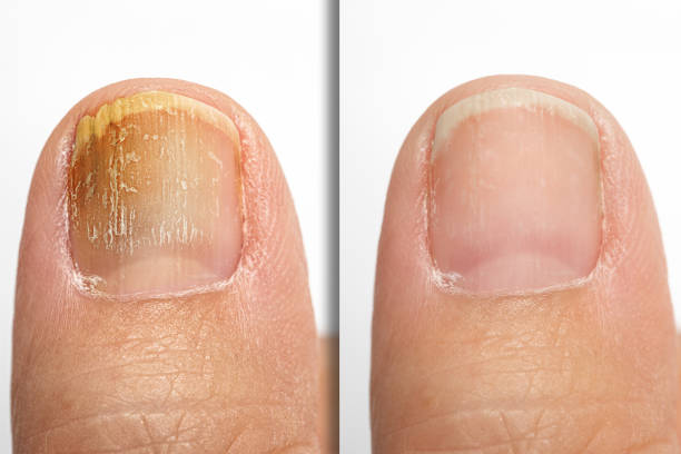 Dites Adieu aux Mycoses des Ongles : Guide pour des Pieds Sains et Beaux chez Ideal Body Clinic