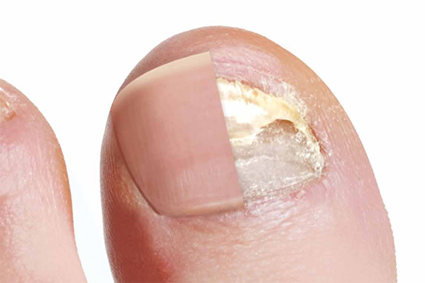Dites Adieu aux Champignons des Ongles : Élimination Efficace avec le Traitement au Laser Fotona