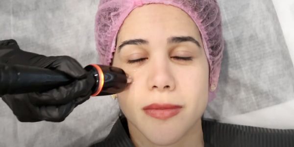 Obtenez un lifting du visage triLift à Montréal à la Clinique Corps Idéal