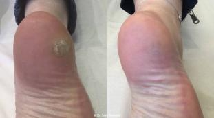 Comprendre les Verrues : Causes, Types et Traitements Efficaces