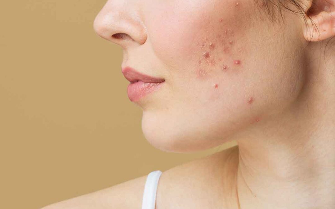 🌟 Solutions pour une peau claire : Protocoles anti-acné avancés à la Clinique Corps Idéal