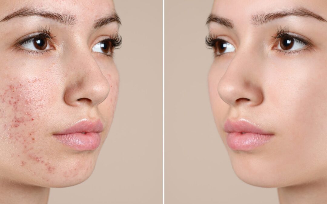 Advanced Acne Treatments: AviClear & Fotona Laser for Clear, Healthy Skin