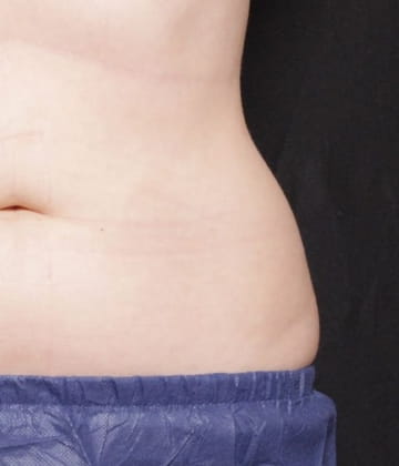 After love handles picture Venus Bliss Max Contouring treatment