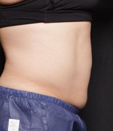 After fat abdomen picture Venus Bliss Max Contouring in Montreal