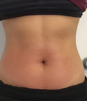 After picture of fat reduction treatment in abdomen area with Venus Bliss Max treatment in Montreal