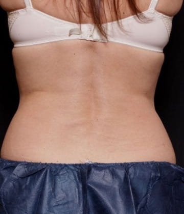Love handles and back reduction after venus bliss max treatment in Montreal