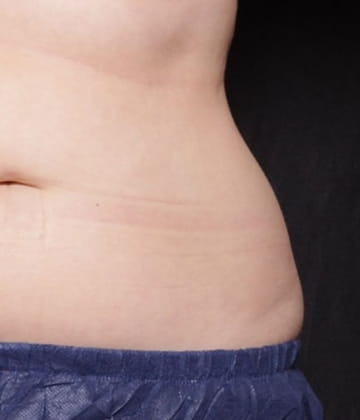 Before love handles picture Venus Bliss Max Contouring treatment
