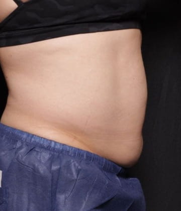 Before fat abdomen picture Venus Bliss Max Contouring in Montreal